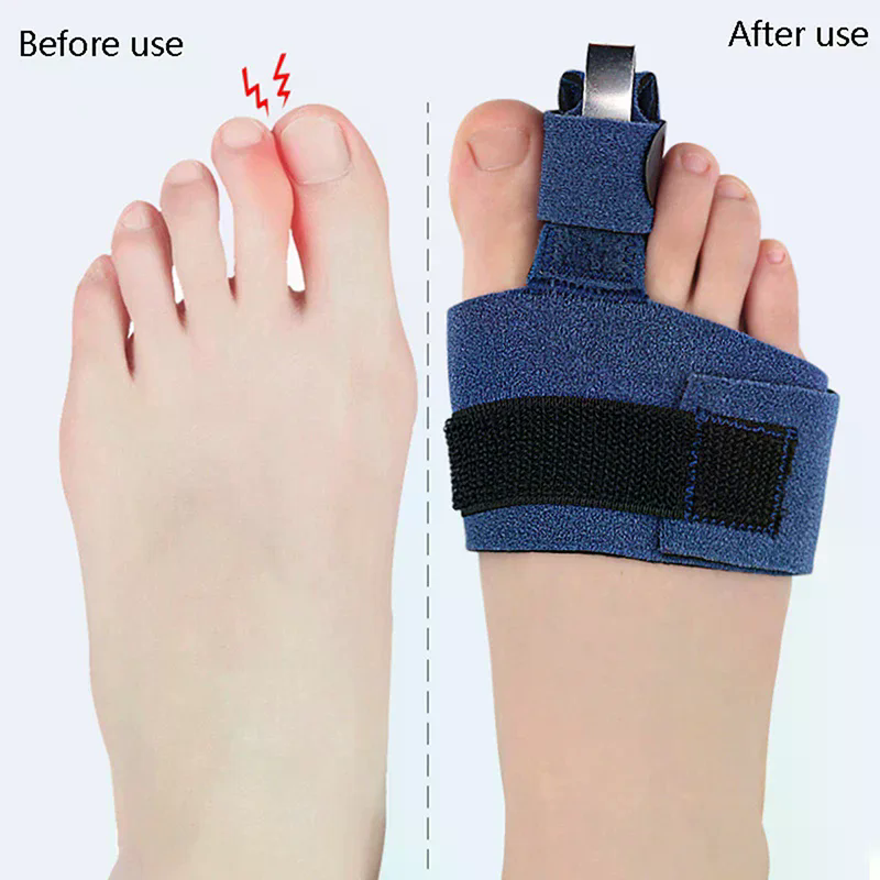 1Pcs Toe Corrector Toe Fractur - огляд і ціна Ankle Brace Sock
